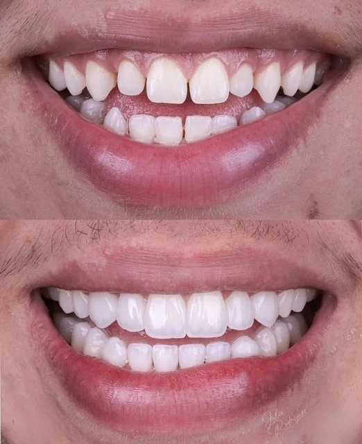 Full transformation: before treatment, the smile lacked proper symmetry and exhibited age-related discoloration; after treatment, restorative cosmetic dentistry provided properly aligned, vibrant ceramic restorations with natural texture.